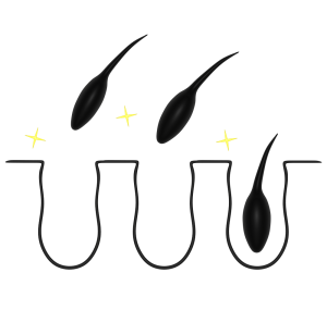 脱毛する毛穴断面のイラスト